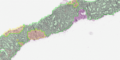 Using AI to identify the aggressiveness of prostate cancer