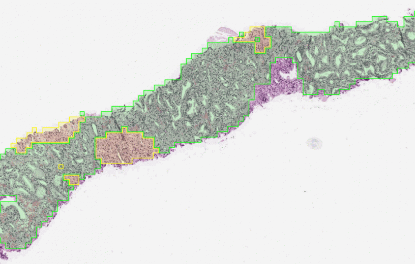 Using AI to identify the aggressiveness of prostate cancer